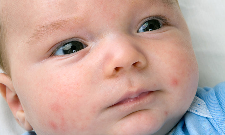 FAQ: What Is Baby Acne?