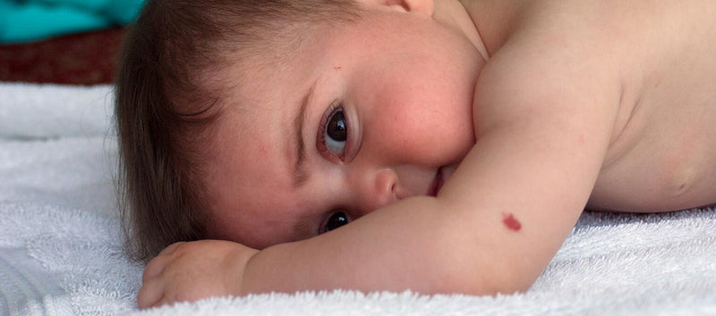 What Is a Birthmark and What Types Are There?