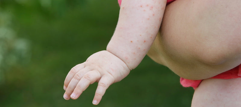 FAQ: Heat Rash in Babies and Toddlers