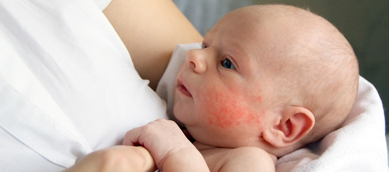 Common Rashes in Newborn Babies