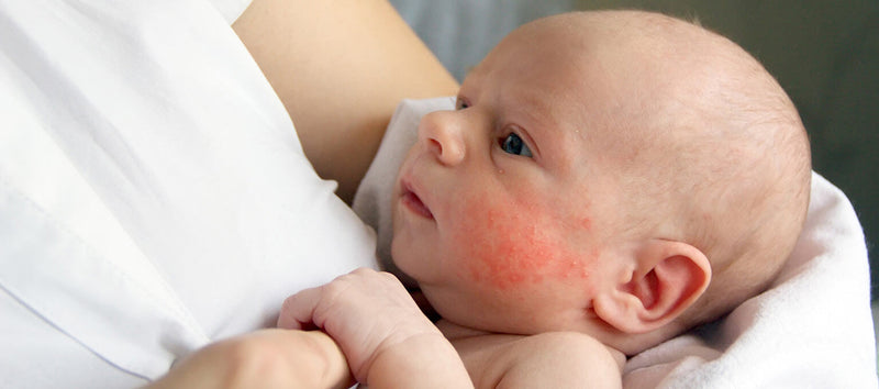 What to Do When Your Baby Has Eczema