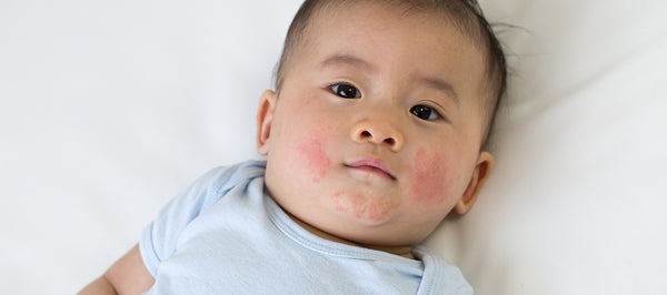 FAQ: What Is Fifth Disease?